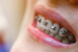 Close-up of a person smiling with metal braces.